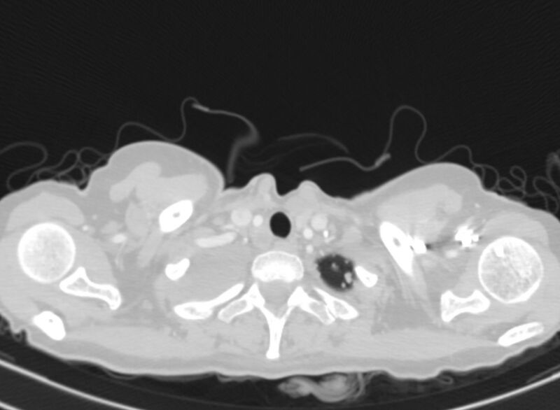File:Cannonball metastases from breast cancer (Radiopaedia 91024-108569 Axial lung window 2).jpg