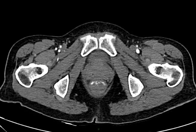 File:Carcinoid mesenteric tumor complicated by chylous ascites (Radiopaedia 76312-88926 A 79).jpg
