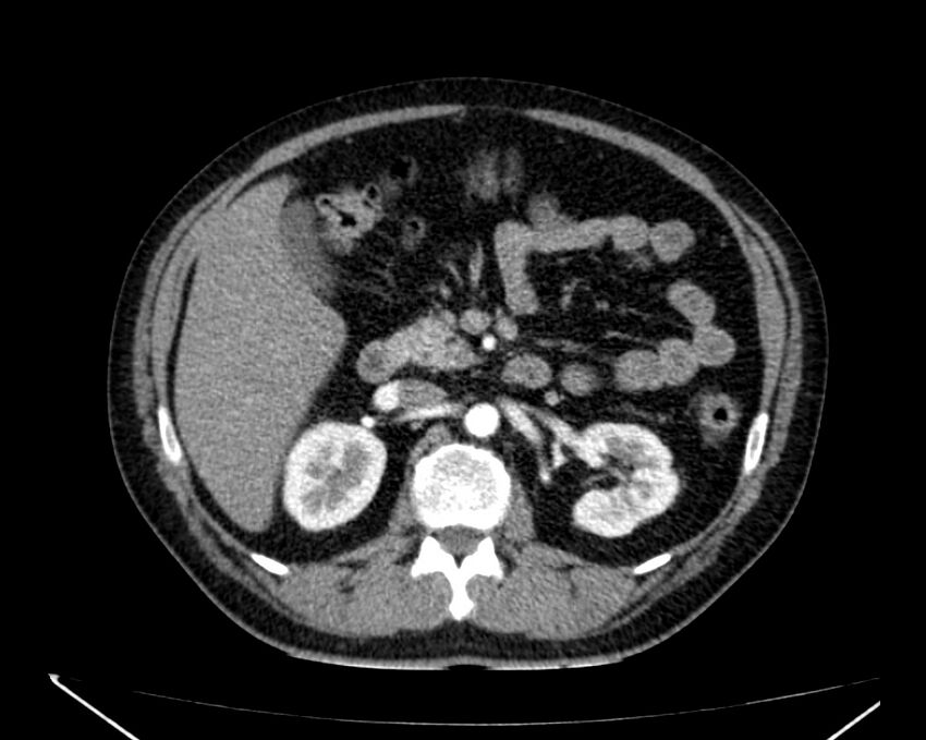 Carcinoid tumor with hepatic metastases (Radiopaedia 22651-22670 B 34).jpg