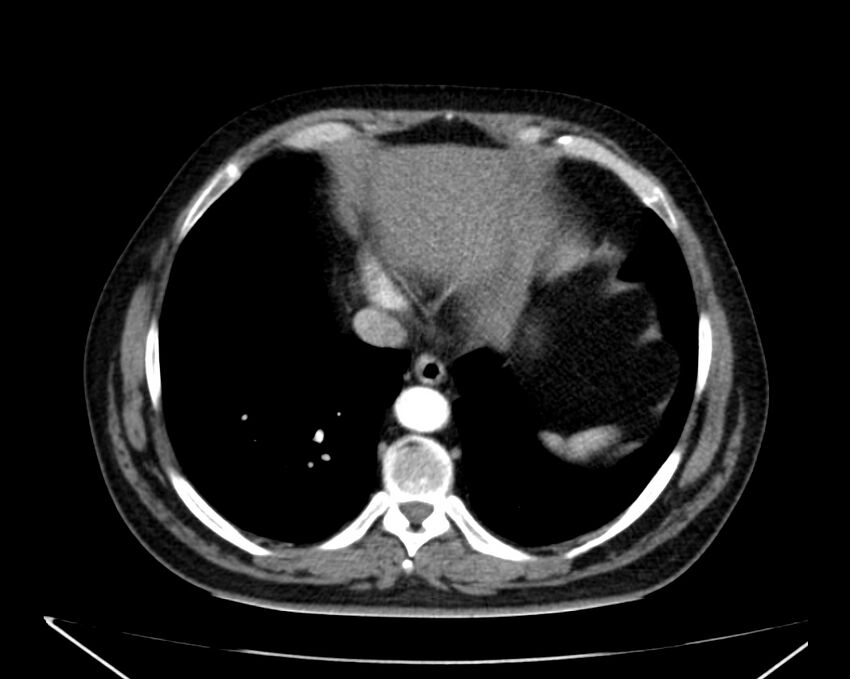 Carcinoid tumor with hepatic metastases (Radiopaedia 22651-22670 B 8).jpg