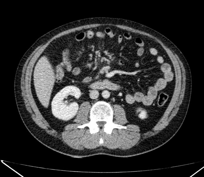 File:Carcinoid tumor with hepatic metastases (Radiopaedia 22651-22670 C 50).jpg