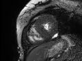 Cardiac amyloidosis (Radiopaedia 61600-69579 Short axis bSSFP 78).jpg