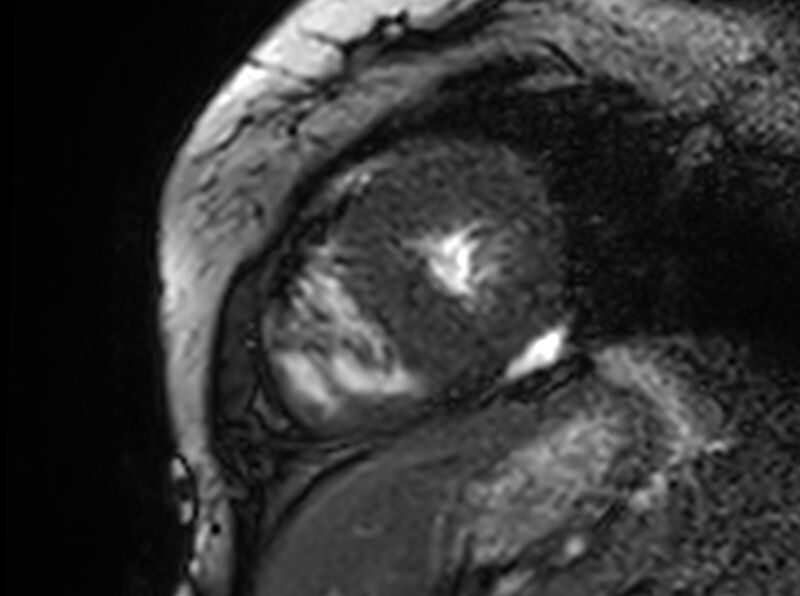 File:Cardiac amyloidosis (Radiopaedia 61600-69579 Short axis bSSFP 78).jpg