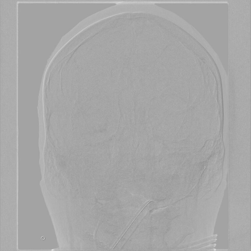 Caroticocavernous fistula - direct (Radiopaedia 61660-69666 A 49).jpg