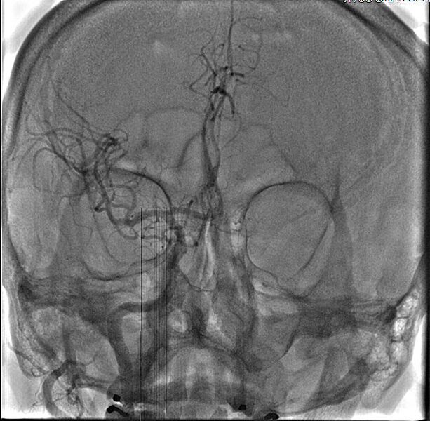 File:Carotid angioplasty (Radiopaedia 16766-16479 E 1).jpg
