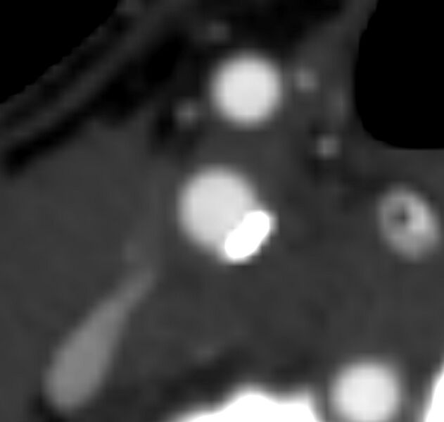 File:Carotid near-occlusion (Radiopaedia 85304-100887 M 54).jpg