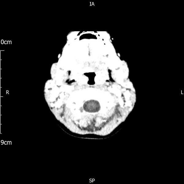 File:Cavernous sinus thrombosis (Radiopaedia 79414-92510 Axial Brain 28).jpg