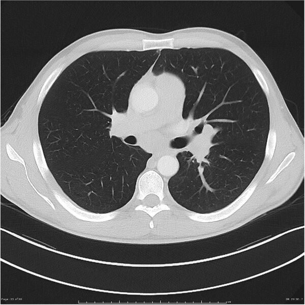 File:Cavitating lung cancer (Radiopaedia 25796-25945 Axial lung window 25).jpg