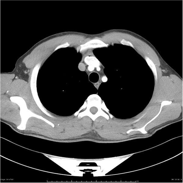 File:Cavitating lung cancer (Radiopaedia 25796-25945 C+ arterial phase 10).jpg