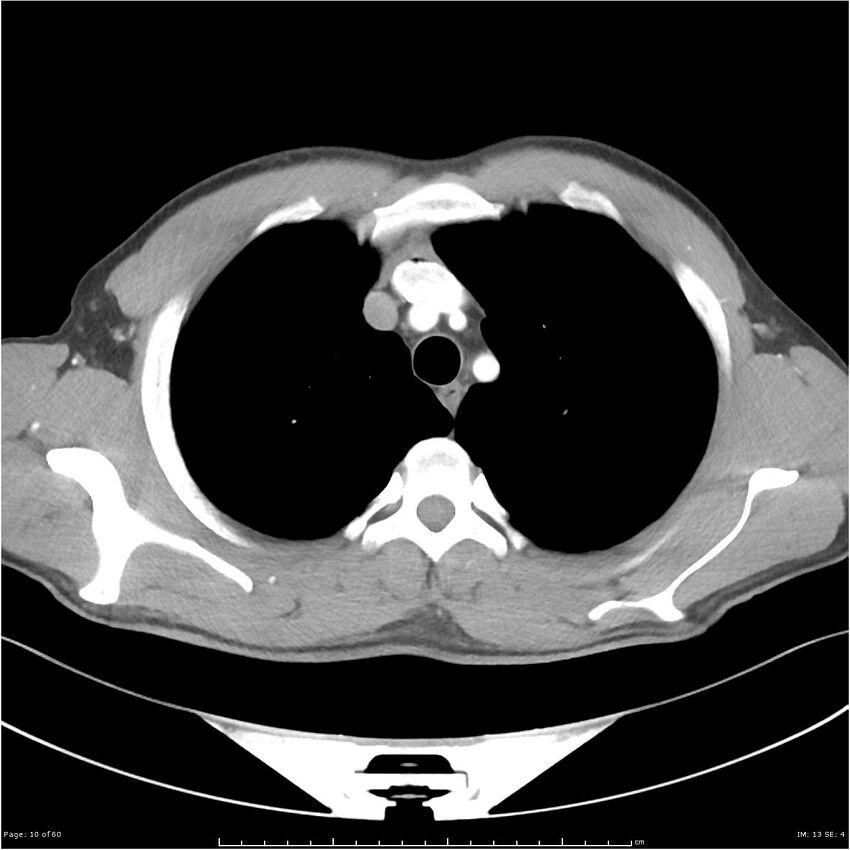 Cavitating lung cancer (Radiopaedia 25796-25945 C+ arterial phase 10).jpg