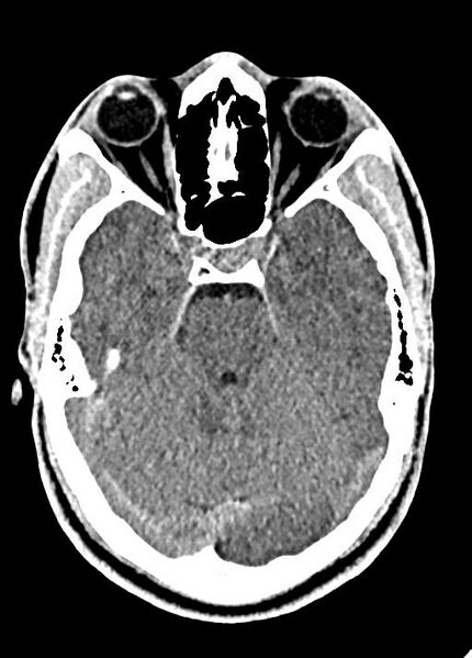 File:Cavum septum pellucidum and cavum vergae (Radiopaedia 77797-90060 Axial Brain Window 35).jpg