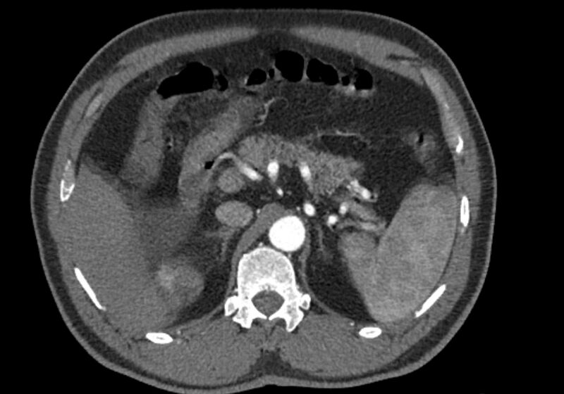 File:Celiac artery dissection (Radiopaedia 52194-58080 A 27).jpg
