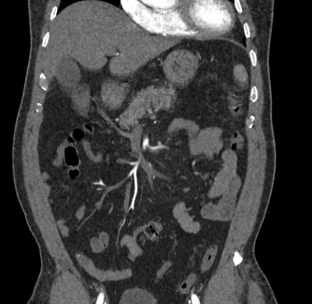 File:Celiac artery dissection (Radiopaedia 52194-58080 C 13).jpg