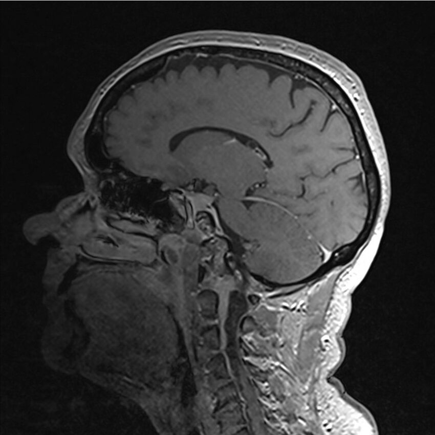 Central base of skull meningioma (Radiopaedia 53531-59549 Sagittal T1 C+ 11).jpg