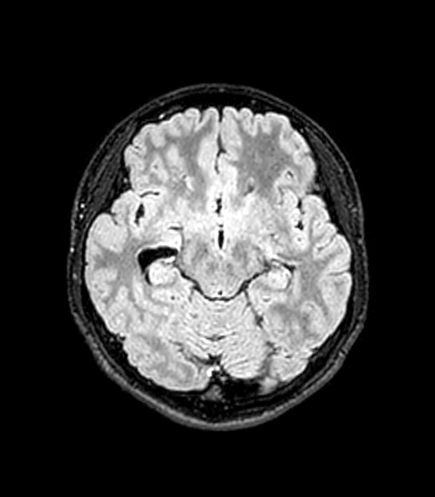 Central neurocytoma (Radiopaedia 79320-92380 Axial FLAIR 187).jpg