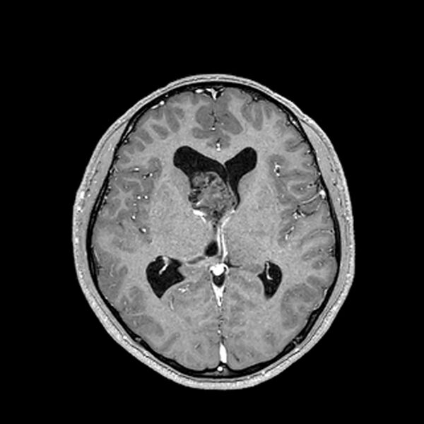 File:Central neurocytoma (Radiopaedia 79320-92380 Axial T1 C+ 130).jpg