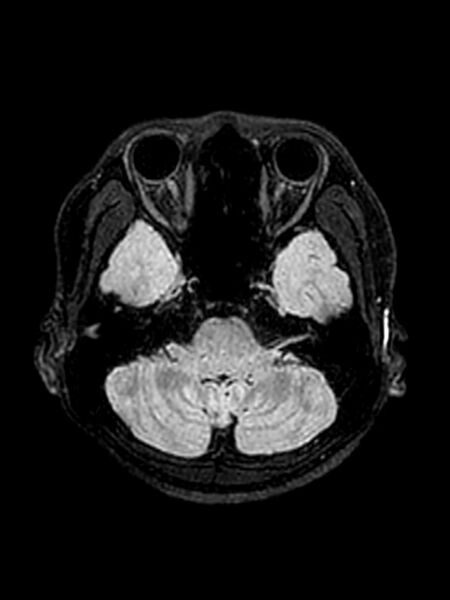 File:Central neurocytoma (Radiopaedia 79320-92381 Axial FLAIR 125).jpg
