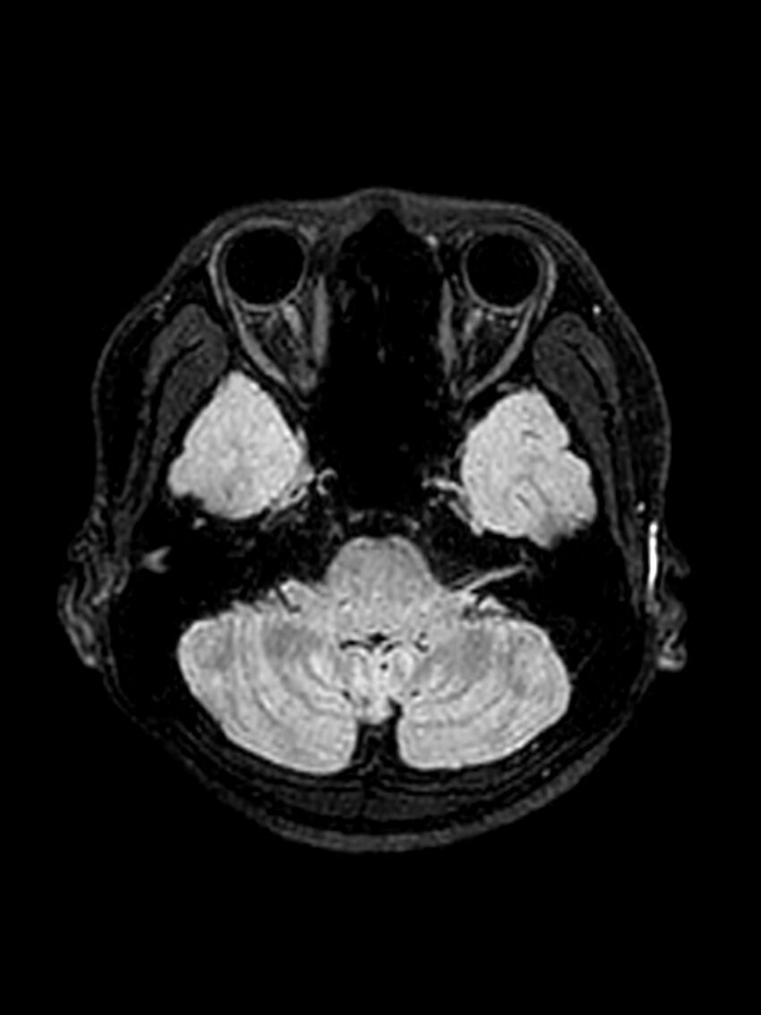Central neurocytoma (Radiopaedia 79320-92381 Axial FLAIR 125).jpg