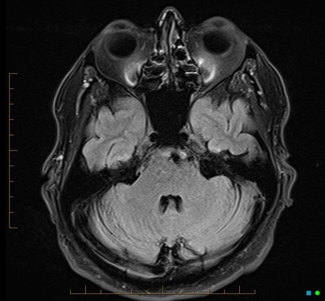 File:Cerebellar gangliocytoma (Radiopaedia 65377-74422 Axial FLAIR 10).jpg