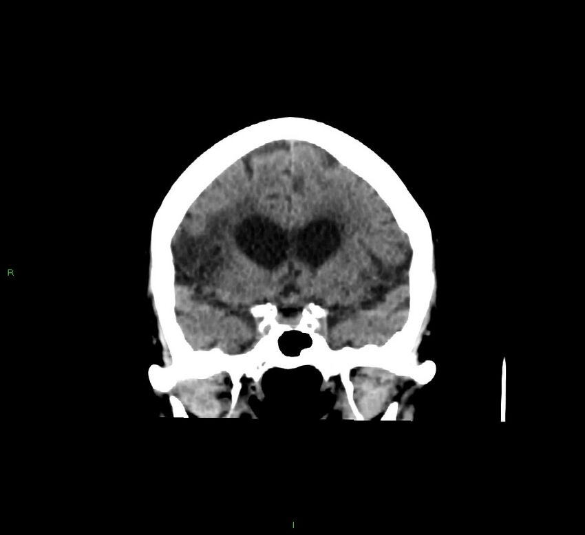 Cerebellar hemorrhage (Radiopaedia 58793-66027 Coronal non-contrast 45).jpg