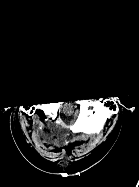 File:Cerebellar infarct due to vertebral artery dissection with posterior fossa decompression (Radiopaedia 82779-97032 Axial non-contrast 2).png