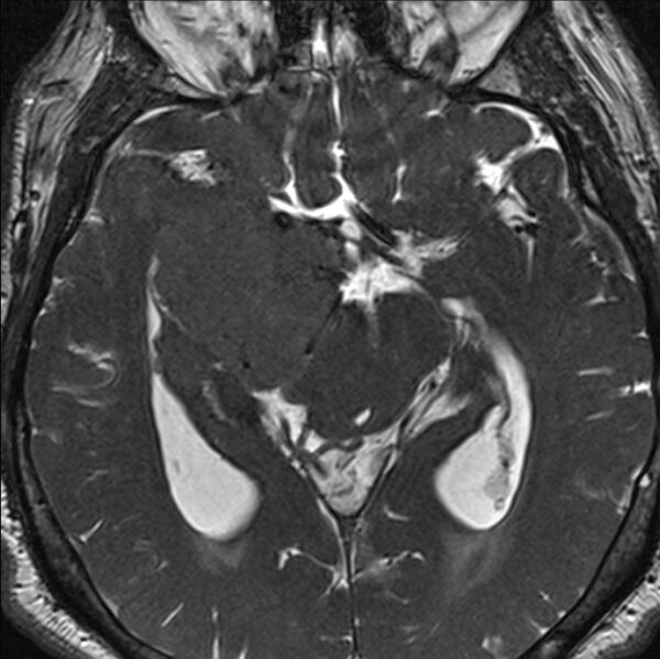 File:Cerebellopontine angle meningioma (Radiopaedia 24459-24764 I 44).jpg