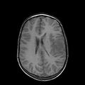 Cerebral abscess post cardiac surgery (Radiopaedia 27244-27420 Axial T1 16).jpg