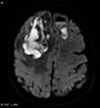 Cerebral abscesses secondary to contusions (Radiopaedia 5201-6968 Axial DWI 1).jpg