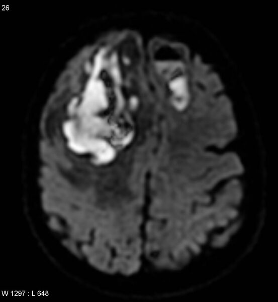 File:Cerebral abscesses secondary to contusions (Radiopaedia 5201-6968 Axial DWI 1).jpg