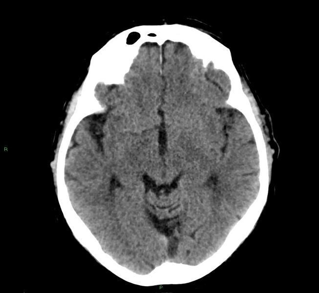 File:Cerebral amyloid angiopathy-associated lobar intracerebral hemorrhage (Radiopaedia 58376-65511 Axial non-contrast 34).jpg