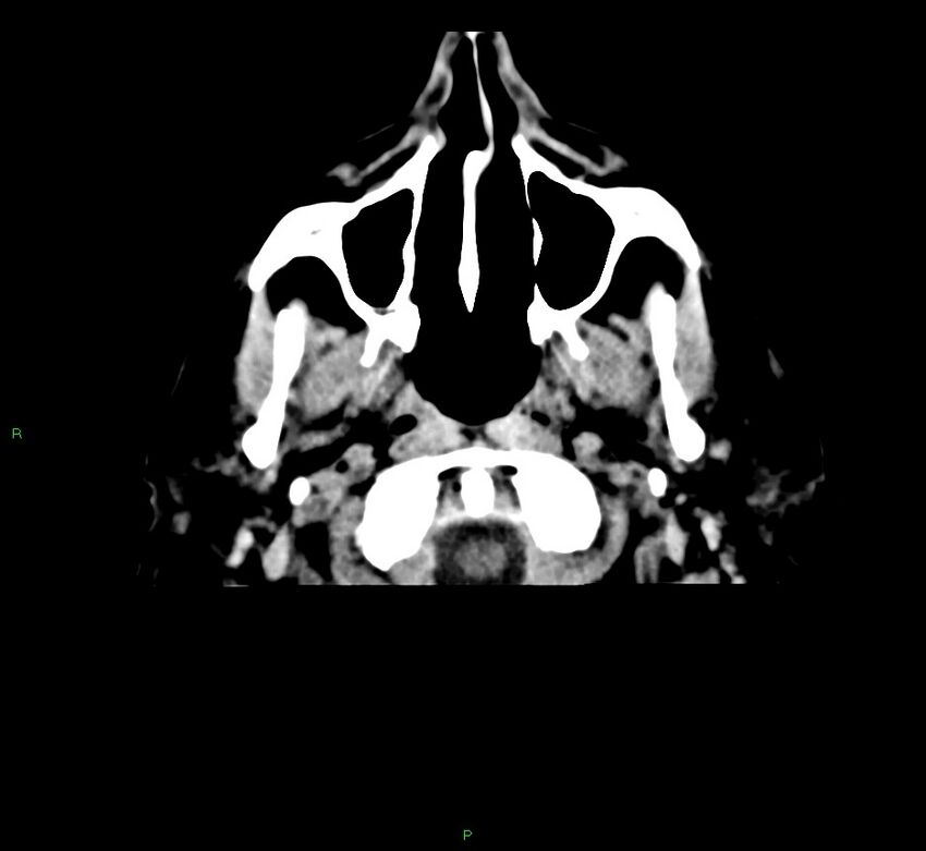 Cerebral amyloid angiopathy-associated lobar intracerebral hemorrhage (Radiopaedia 58376-65511 Axial non-contrast 54).jpg
