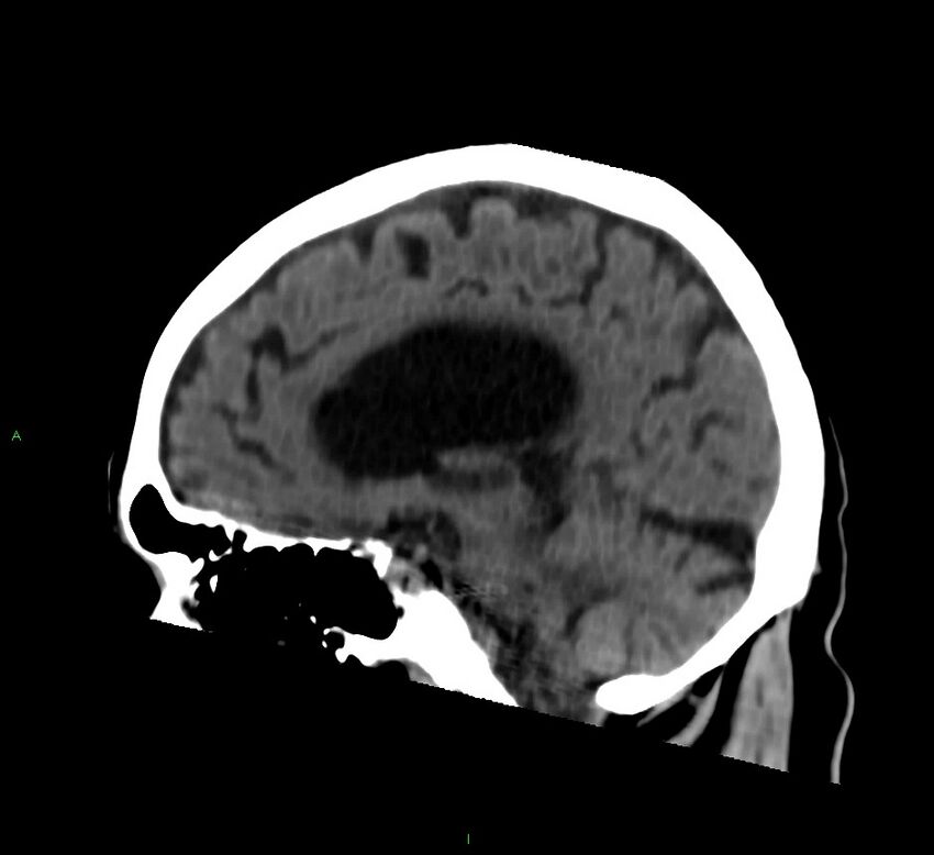 Cerebral amyloid angiopathy-associated lobar intracerebral hemorrhage (Radiopaedia 58376-65513 C 41).jpg