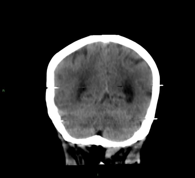 File:Cerebral amyloid angiopathy-associated lobar intracerebral hemorrhage (Radiopaedia 58377-65514 Coronal non-contrast 19).jpg