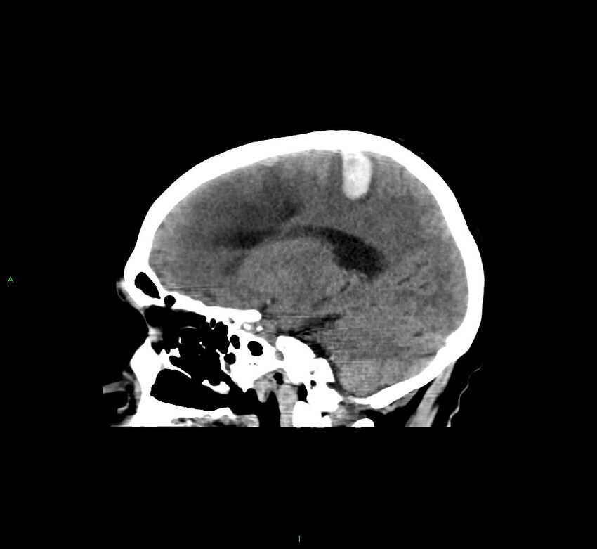 Cerebral amyloid angiopathy-associated lobar intracerebral hemorrhage (Radiopaedia 58529-65681 B 30).jpg