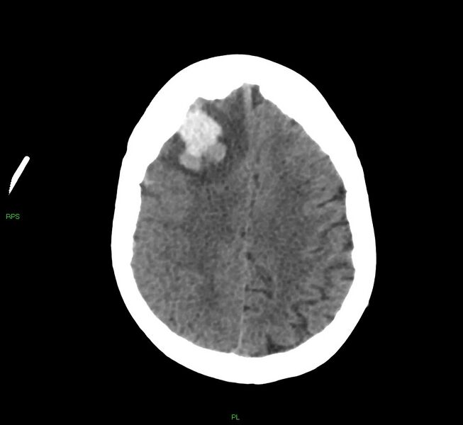 File:Cerebral amyloid angiopathy-associated lobar intracerebral hemorrhage (Radiopaedia 58569-65734 Axial non-contrast 22).jpg