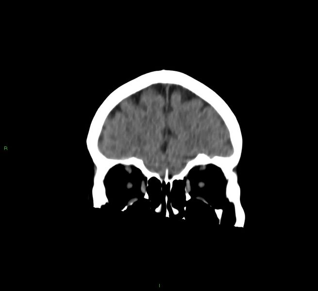 File:Cerebral amyloid angiopathy-associated lobar intracerebral hemorrhage (Radiopaedia 58757-65978 Coronal non-contrast 54).jpg