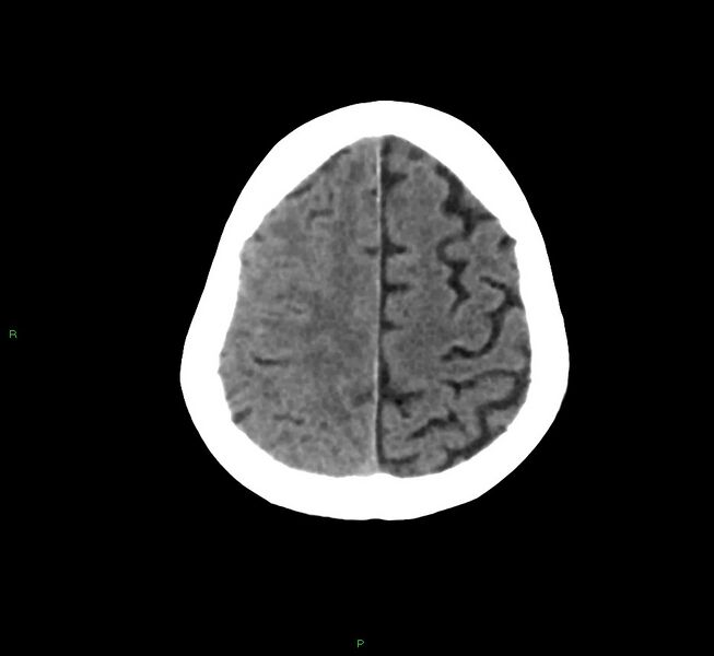 File:Cerebral amyloid angiopathy-associated lobar intracerebral hemorrhage (Radiopaedia 58758-65980 Axial non-contrast 11).jpg