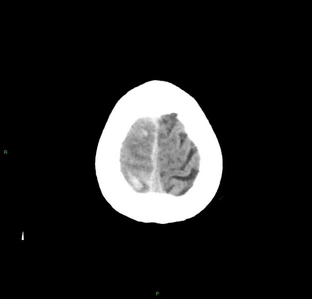 File:Cerebral amyloid angiopathy-associated lobar intracerebral hemorrhage (Radiopaedia 59356-66716 Axial non-contrast 5).jpg