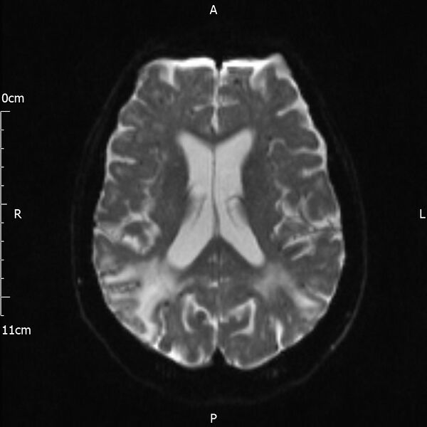 File:Cerebral amyloid angiopathy related inflammation (Radiopaedia 72772-83415 Axial DWI 14).jpg