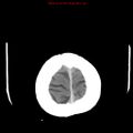 Cerebral and orbital tuberculomas (Radiopaedia 13308-13310 B 27).jpg