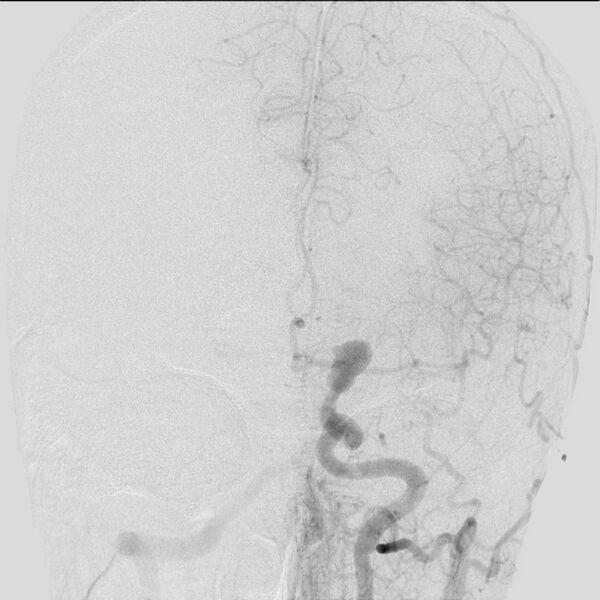 File:Cerebral aneurysm with rupture (Radiopaedia 29933-30458 LT ICA IC 17).jpg