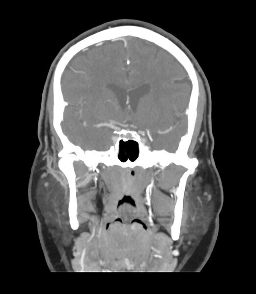 File:Cerebral dural venous sinus thrombosis (Radiopaedia 86514-102576 B 26).jpg