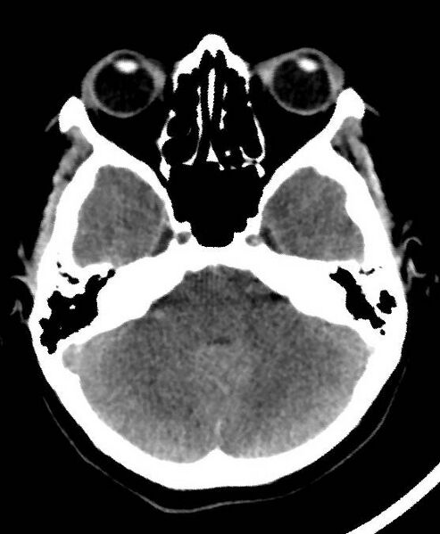 File:Cerebral edema due to severe hyponatremia (Radiopaedia 89826-106937 Axial non-contrast 22).jpg