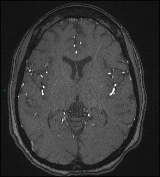 File:Cerebral fat embolism (Radiopaedia 35022-36525 Axial TOF 105).jpg