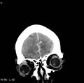 Cerebral hemorrhagic contusion with subdural and subarachnoid hemorrhage (Radiopaedia 10680-11146 Coronal non-contrast 2).jpg