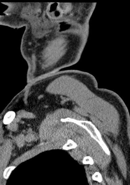 File:Cerebral hemorrhagic contusions and cervical spine fractures (Radiopaedia 32865-33841 G 108).jpg