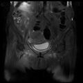 Cervical carcinoma (Radiopaedia 78847-91705 Coronal T2 fat sat 5).jpg