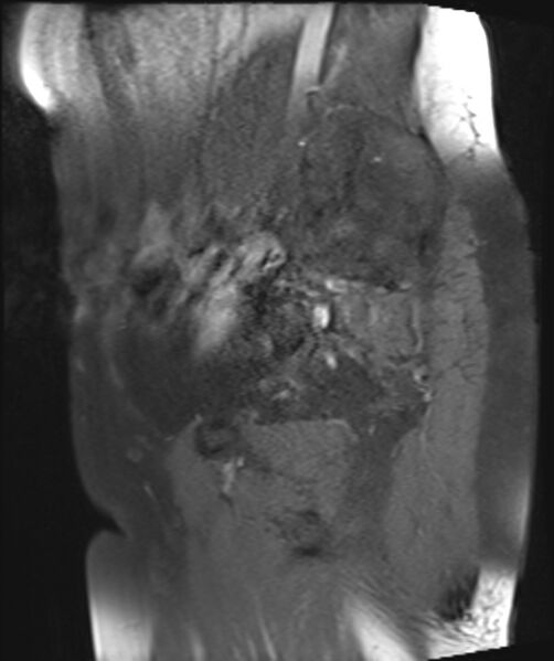 File:Cervical carcinoma (Radiopaedia 88312-104943 Sagittal T1 fat sat 23).jpg