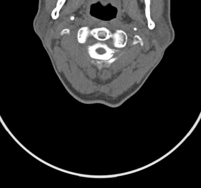 Cervical dural CSF leak on MRI and CT treated by blood patch (Radiopaedia 49748-54996 B 15).png