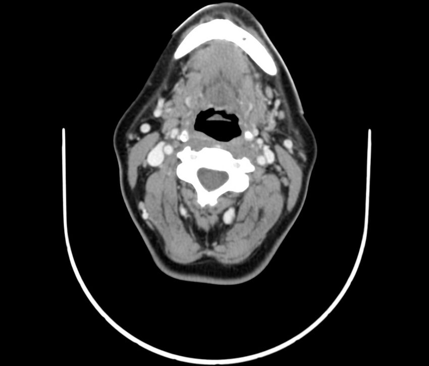 Cervical venous malformation (Radiopaedia 22653-22672 Axial C+ delayed 32).jpg